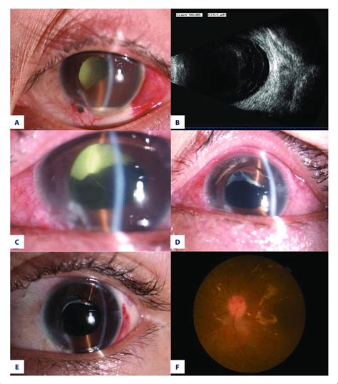 Pseudomonas Aeruginosa Infection In Eye - Carpet Vidalondon