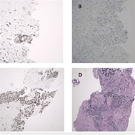 Histopathology Hande And Immunohistochemistry Of Liver Mass On Needle