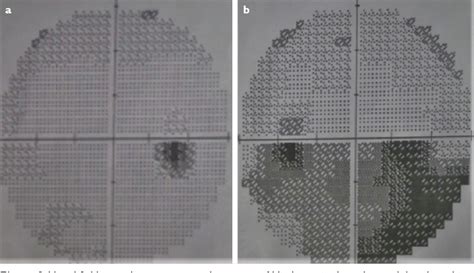 Pdf Bilateral Sequential Non Arteritic Anterior Ischemic Optic