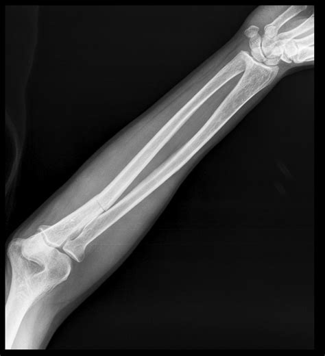 Ulnar Bone Fracture