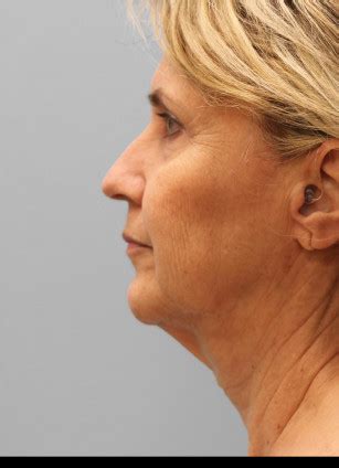 Facelift Laser Dr Tucker Salem Plastic Surgery