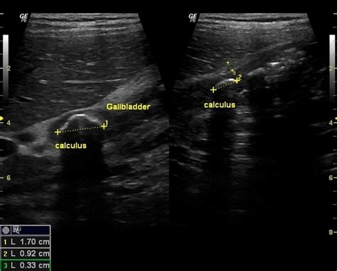 Cholelithiasis Ultrasound