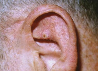 Ear Pain As Related To Benign Ear Cyst Or Tumor Pictures