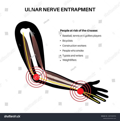 Ulnar Nerve Entrapment Cubital Tunnel Syndrome Stock Vector Royalty