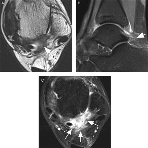 Posterior Ankle Impingement In Athletes Pathogenesis Imaging Features