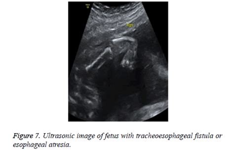 Tracheoesophageal Fistula Ultrasound