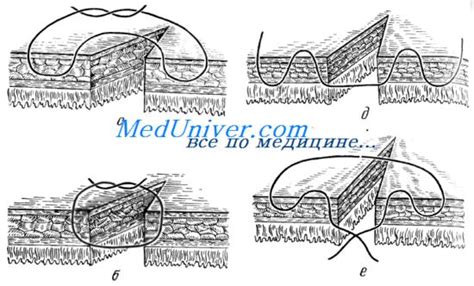 Классификация кишечных швов. Проникающие швы. Непроникающие швы.