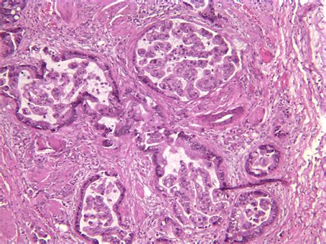 Late Presentation Of A Mucinous Ovarian Adenocarcinoma Which Was