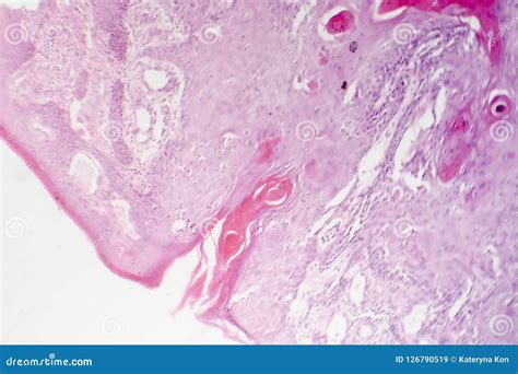 Squamous Cell Carcinoma Skin Histology