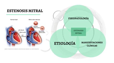 Estenosis Mitral By Altamirano Garc A Lizbeth On Prezi