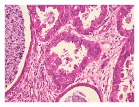 Microscopic Findings For Ovaries Ad And The Sigmoid Colon E F