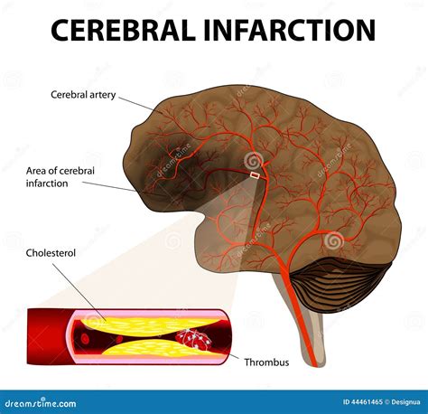 Cerebral Infarction Or Ischemic Stroke Stock Vector - Illustration of ...