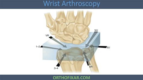 Wrist Arthroscopy • Easy Tutorial • Orthofixar 2024