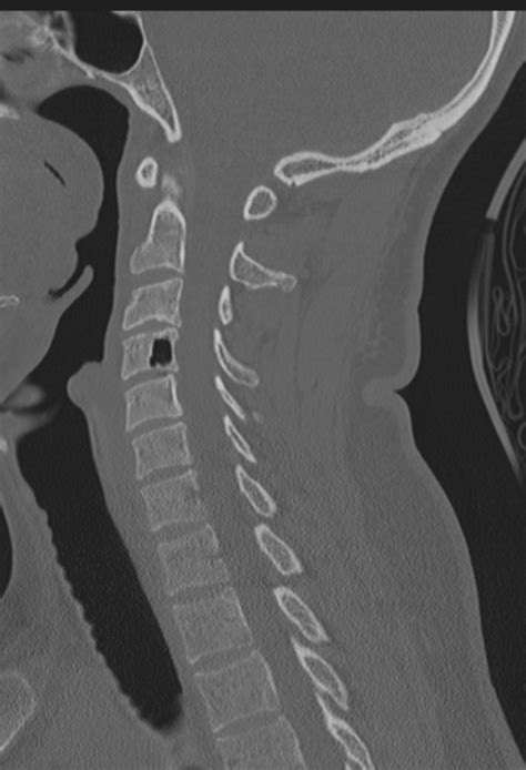 Vertebral pneumatocyst | Image | Radiopaedia.org