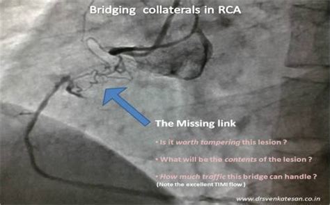 Bridging Collaterals Drsvenkatesan Md