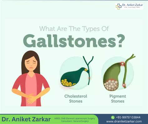 Gallstones Symptoms Causes Treatment By Draniketzarkar Sep 2024