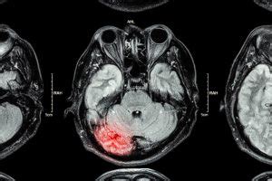 Brain Changes in Post-Traumatic Seizures - The Defeating Epilepsy ...