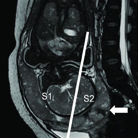 Mri Aspect Of The Anterior Uterine Sacculation Containing The Placenta Download Scientific