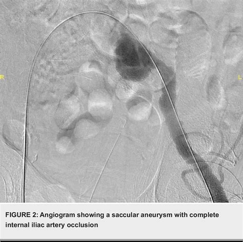 Figure From Incidental Unruptured Isolated Left Common Iliac Artery