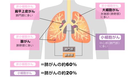 肺がんについて Newsline Lsi札幌クリニック