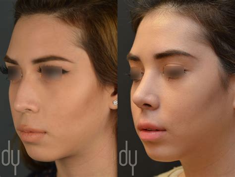 Beverly Hills Rhinoplasty Specialist Dr Donald Yoo Performed A Primary