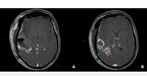 Postoperative Magnetic Resonance Imaging MRI A Shows Axial T1 MRI