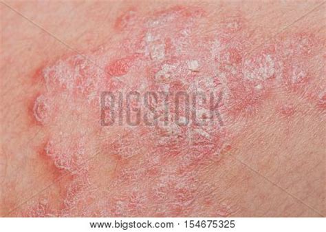 Psoriasis Skin. Image & Photo (Free Trial) | Bigstock