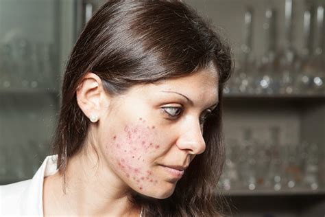 Acne On Cheeks And Jaw Causes And 12 Best Home Remedies Diyvines Do It Yourself