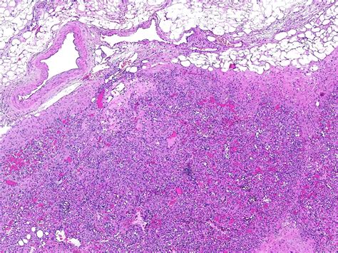 Pathology Outlines Anastomosing Hemangioma