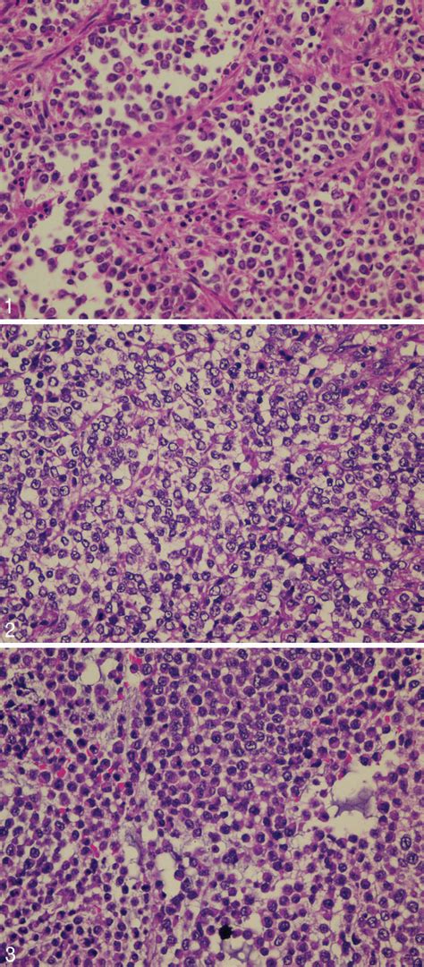 Figure 1 From Undifferentiated Endometrial Carcinoma A Diagnosis