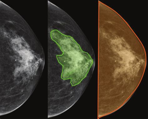 Mammogram Density