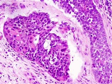 Pathology Outlines Digital Papillary Adenocarcinoma