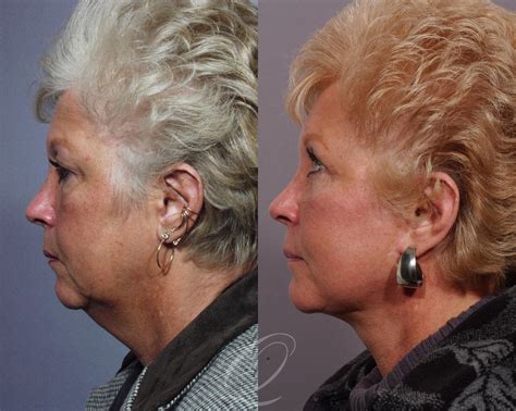 Facelift Before After Photos Patient 305 Serving Rochester