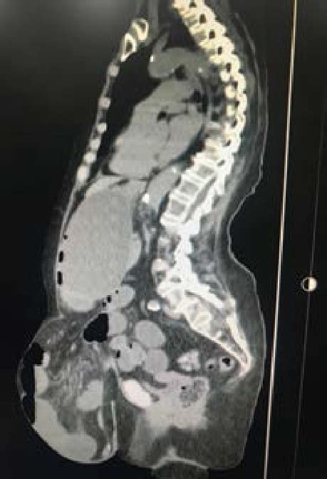 Tomografía axial computarizada de corte sagital con datos de hernia