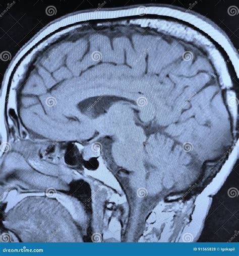 Pituitary Adenoma Brain Image Mri Stock Photography | CartoonDealer.com