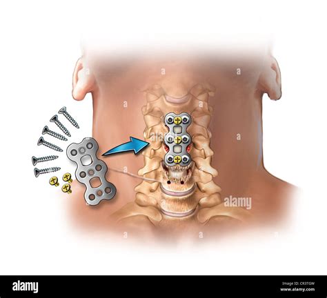 C3-4, C4-5, C5-6 Bone Fusion - Post-operative Condition Stock Photo ...