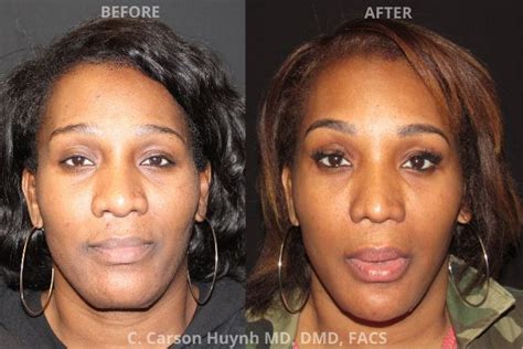 V Line Jawline Surgery Case 2173 Radiance Surgery And Aesthetic Medicine