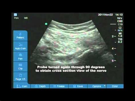 Ultrasound Guided Pudendal Nerve Block