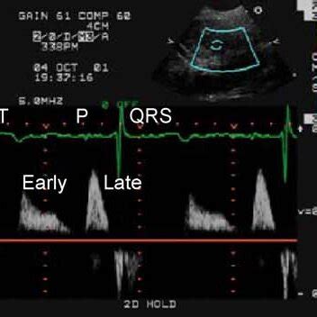 Pulse Wave Doppler Images Showing Biphasic Ventricular Filling Pattern