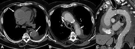 Thoracic Aorta Acute Syndromes Applied Radiology