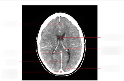 Diagram Radiologie Anatomie Hersenen Quizlet