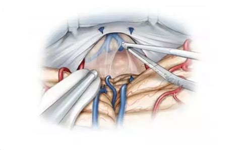 松果体区肿瘤手术入路策略与技巧 The Neurosurgical Atlas全文翻译 脑医汇 神外资讯 神介资讯