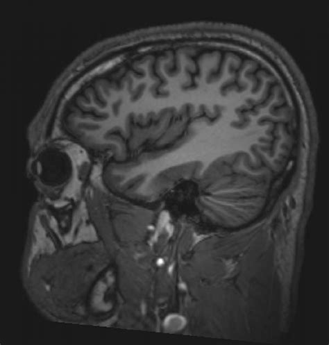 Image: Normal Brain MRI (Sagittal) – Slide 6 - MSD Manual Professional ...