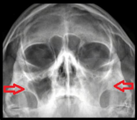 Estudo Radiográfico COMO IDENTIFICAR AS CARACTERÍSTICAS DA SINUSITE