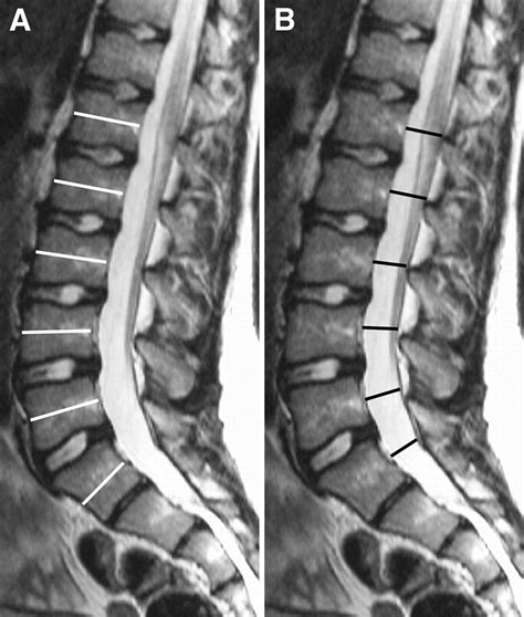 Marfan Syndrome - Pediatrics - Orthobullets