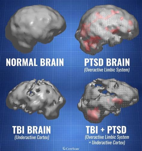 Ptsd Vs C Ptsd Artofit