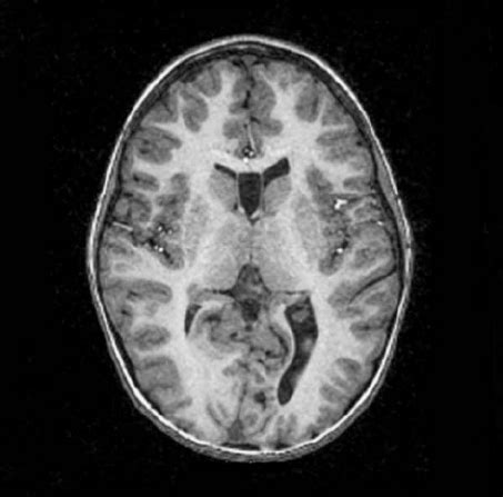 Patient 4 Magnetic Resonance Imaging T1 Three Dimensional FSPGR