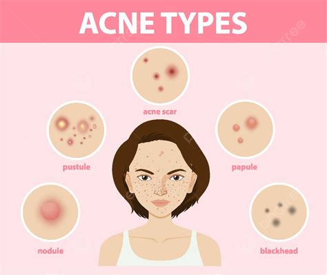 Acne Types Clipart PNG, Vector, PSD, and Clipart With Transparent ...