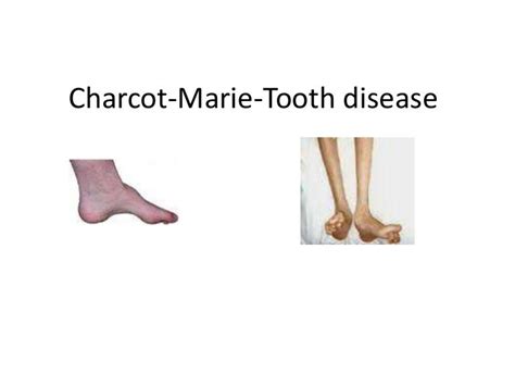 Charcot marie-tooth disease