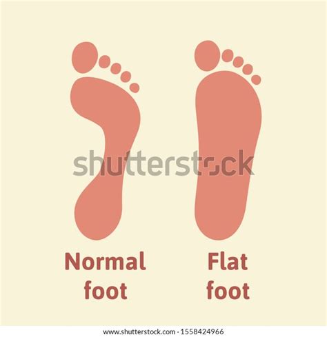 Normal Foot Flat Foot Footprints Diagram Stock Vector Royalty Free